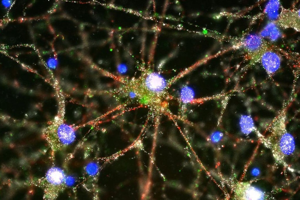 This image provided by Heather de Rivera and made with a fluorescent microscope shows C4 proteins, green, located at the synapses in a culture of human brain neurons. Photo: AP