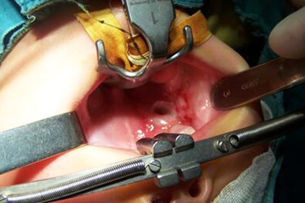 Xuan Xuan undergoes surgery at the Wuhan Children’s Hospital. The toddler was chewing on a used battery when it exploded in her mouth. Photo: SCMP Pictures