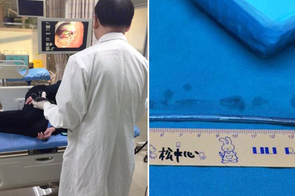 A doctor views the wire via an edoscope before it was safely removed from the man’s stomach, right. Photo: Thepaper.cn