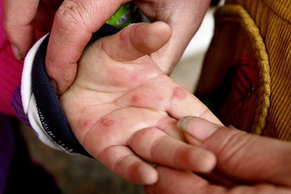 Major outbreaks of hand, foot and mouth disease (HFMD) have been caused by EV71, which was first discovered in 1969. Hundreds of children, mainly in Asia, continue to die from this each year. Photo: Reuters