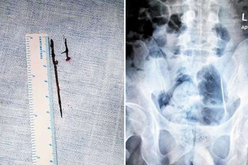 The two needles found inside a Chinese man's body (left), which were spotted after a scan carried out in hospital. Photos: Chutian Metropolis Daily