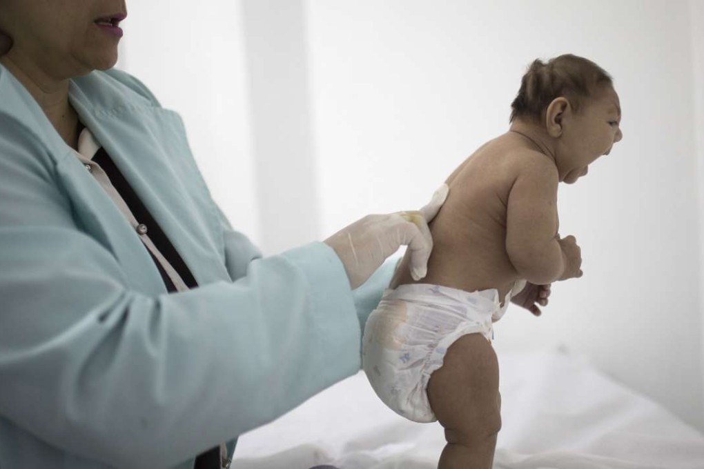 Baby Lara, who is less then 3-months old and was born with microcephaly, is examined by a neurologist at the Pedro I hospital in Campina Grande, Paraiba state, Brazil. Photo: AP