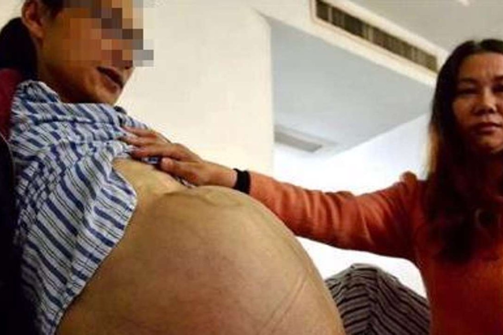 The patient’s waistline had swollen larger than a pregnant woman’s. Photo: Cnhubei.cn