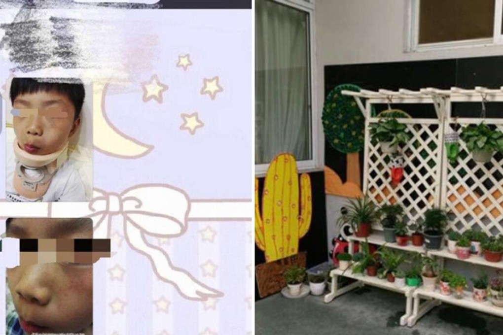 Injuries suffered by the boys at the nursery school in Nanjing. Photo: SCMP Pictures