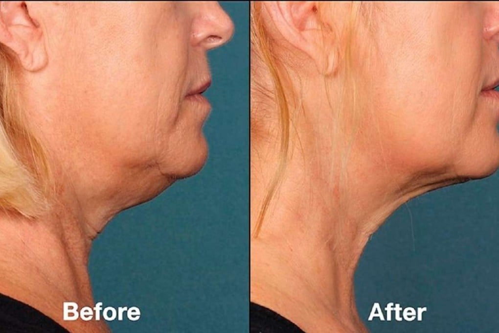 “Before” and “after” shots show the supposed effects of Kybella on a double chin. Photo: Allergan