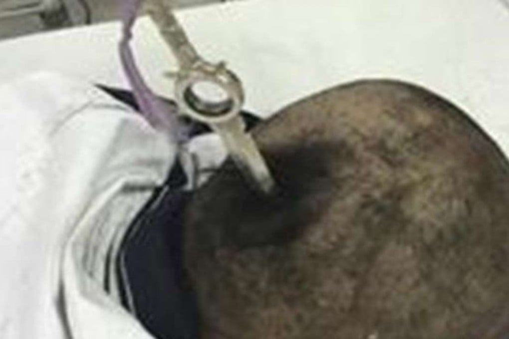 The knife lodged in the girl’s skull. Photo: Sina.com