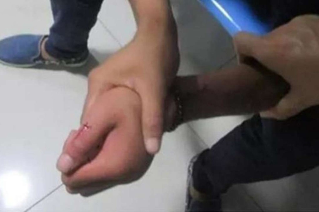 A photograph from the live online feed showing the wound on the teenager’s thumb caused by the snake bite. Photo: SCMP Pictures
