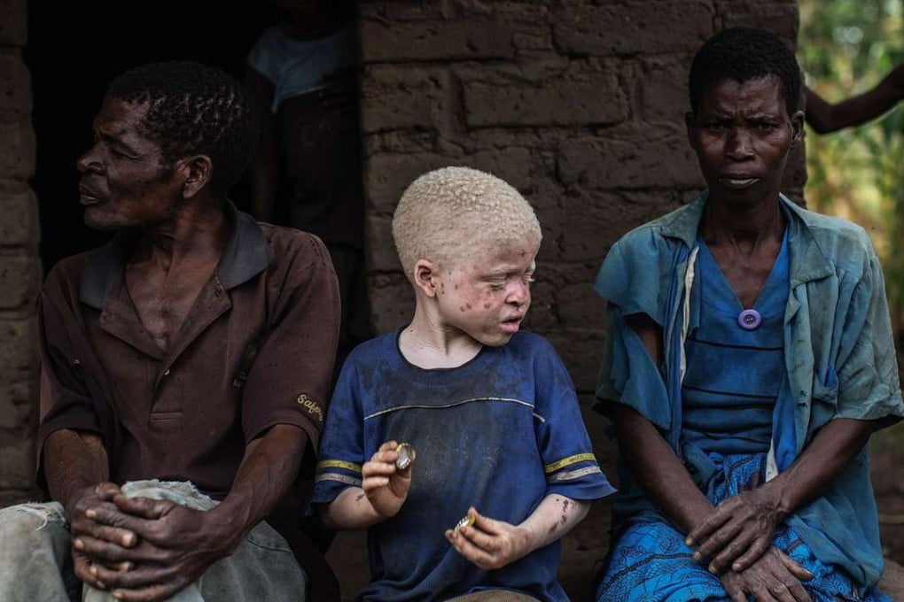 At least 69 crimes against albinos have been documented in Malawi since November 2014. Photo: AFP