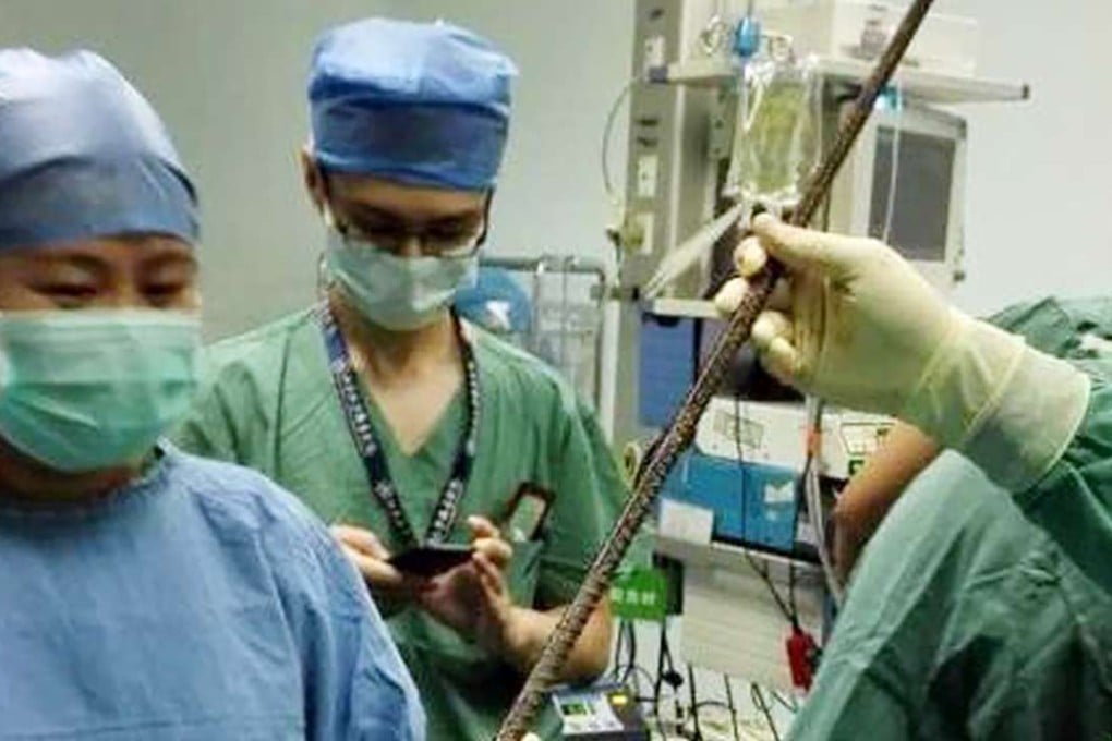 Surgeons with the bar removed from the man’s body. Photo: SCMP Pictures