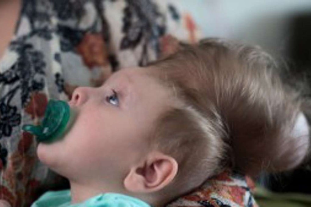 Bentley Yoder before surgery. About one out of every 10,000 children in the US are born with a variation on the same malformation in which part of the brain grows outside the skull, but Bentley’s case was particularly severe. Photo: Katherine C. Cohen-Boston Children's Hospital
