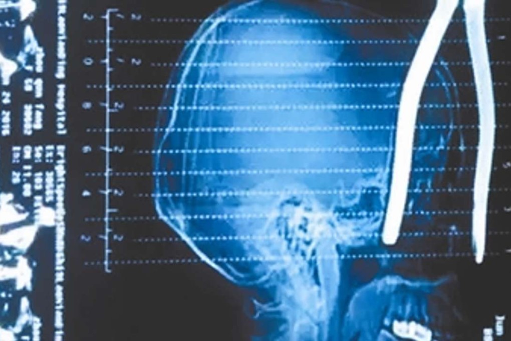 An X-ray of the woman’s injuries. Photo: Chengdu.cn