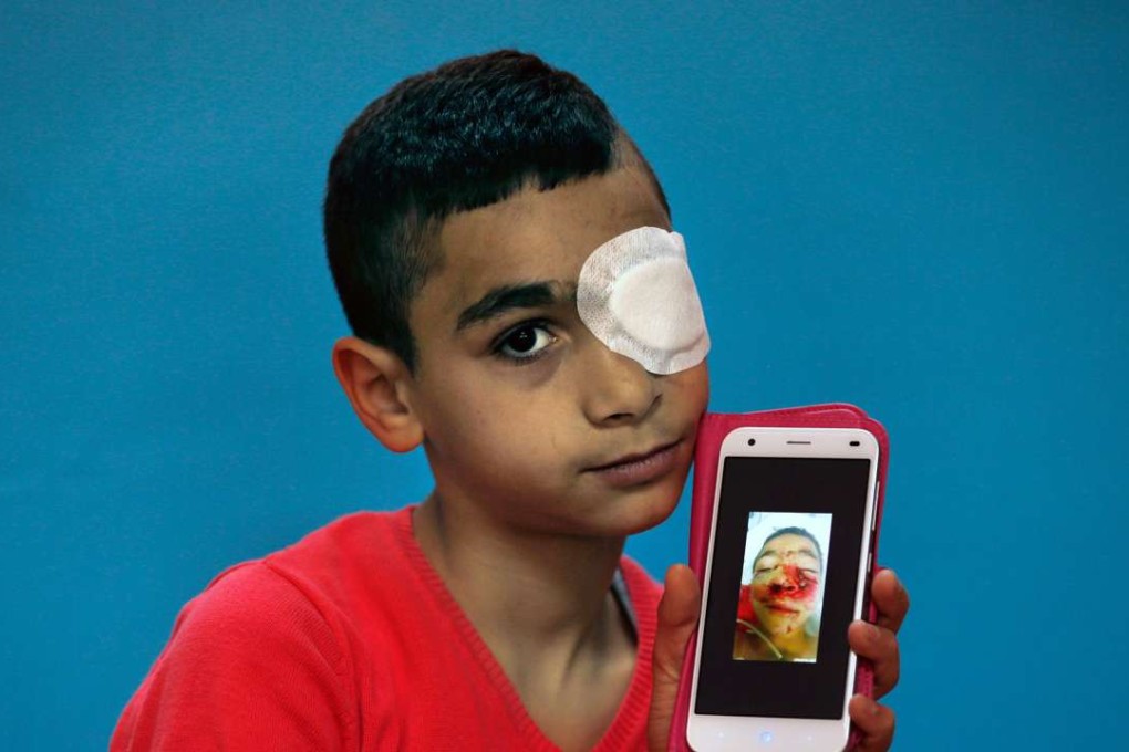 Palestinian boy Yahya Amudi, 11, lost his left eye when he was struck with an Israeli sponge-tipped bullet. Pictured at his family home in east Jerusalem, he poses with a mobile phone showing a picture of himself in hospital. Photo: AFP