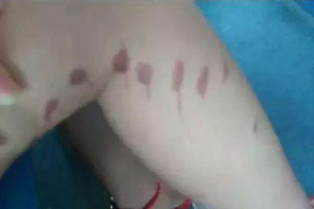 Burns suffered by one of the victims in Fuzhou. Photo: News.qq.com