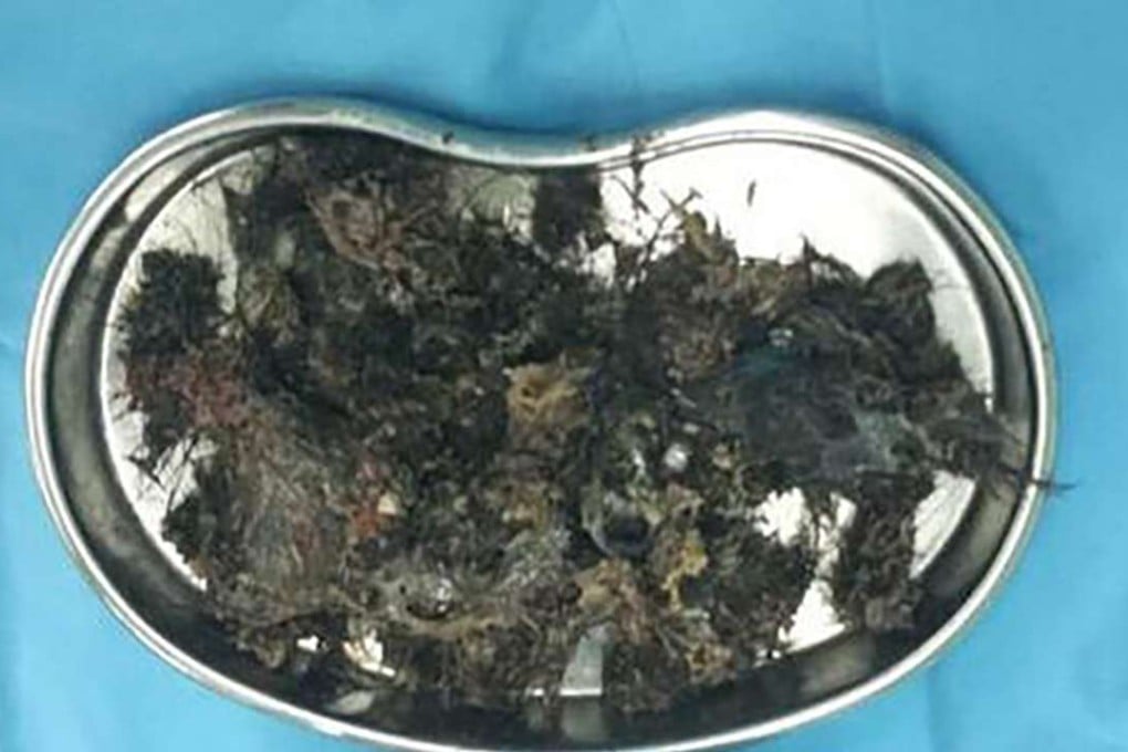Balls of hair were removed from a child’s stomach. Photo: SCMP Pictures