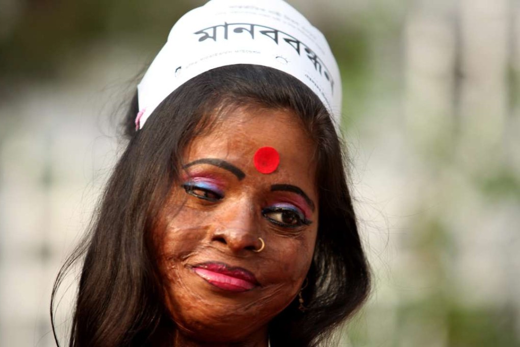 Hasina, a survivor of an acid attack, attends a human chain to protest against acid violence during the International Women's Day celebration in Dhaka in 2012. Photo: EPA