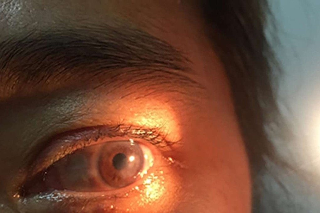 A woman’s eye is inspected after a corneal transplant on Wednesday. Photo: SCMP Pictures