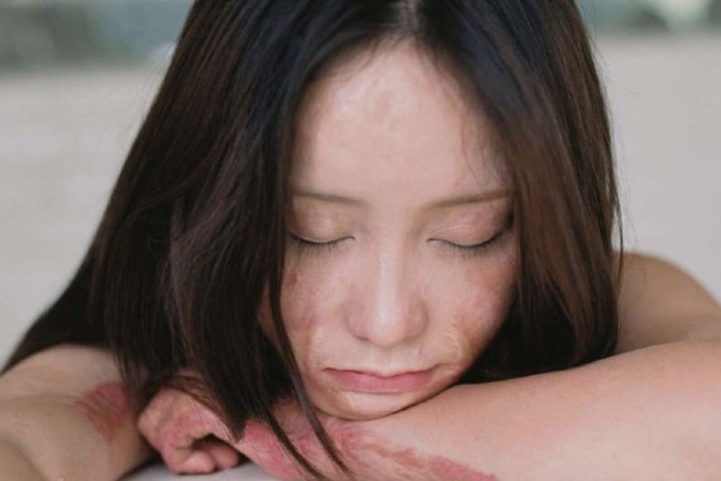 Zhou Yan, 21, was doused in lighter fluid and set alight five years a go by a spurned classmate. Photo: SCMP Pictures.