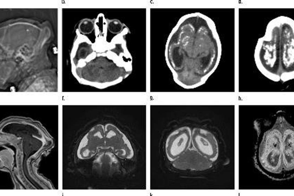 Foetal MRI images obtained in the case of an 18-year-old woman, at 10 weeks of pregnancy, with confirmed Zika virus infection, released as part of a study of patients at the Instituto de Pesquisa in Campina Grande state in Northeastern Brazil. Photo: reuters
