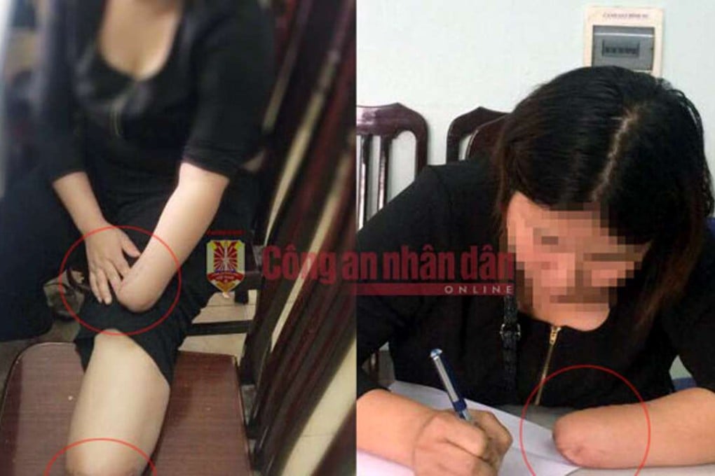 A Vietnamese woman paid a friend to cut off her hand and foot in a bid to claim a handsome insurance payout. Photo: dtinews.vn