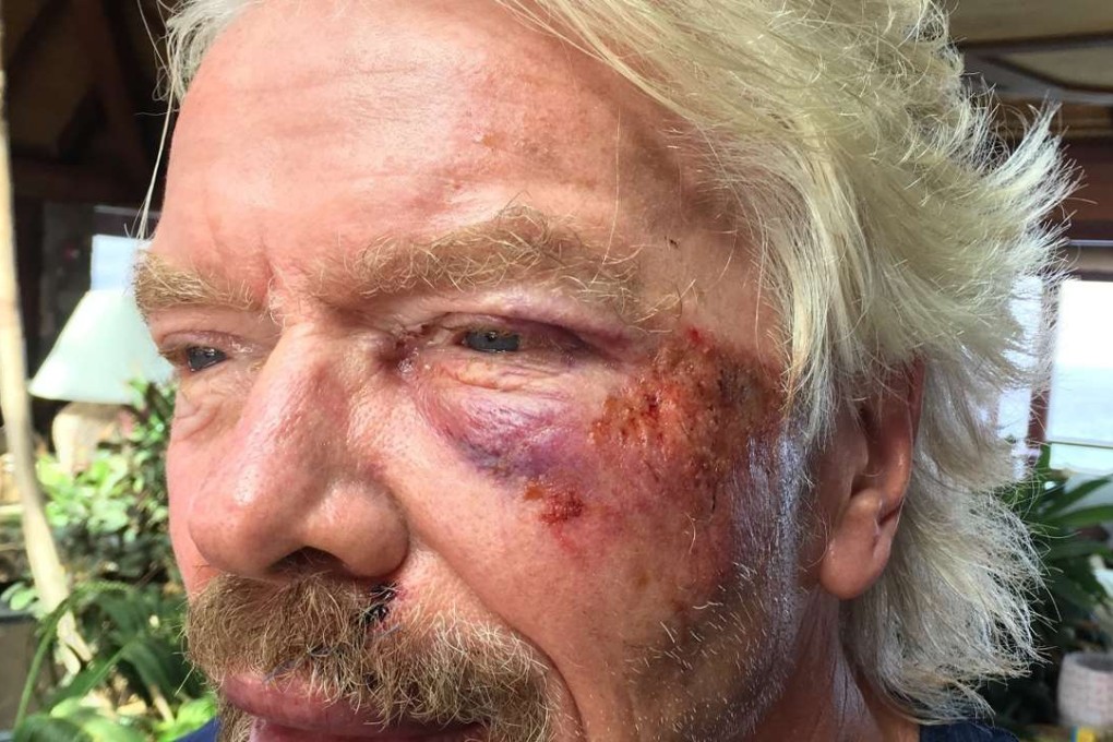 Richard Branson after he was involved in an accident when he crashed his bicycle. Photo: AP