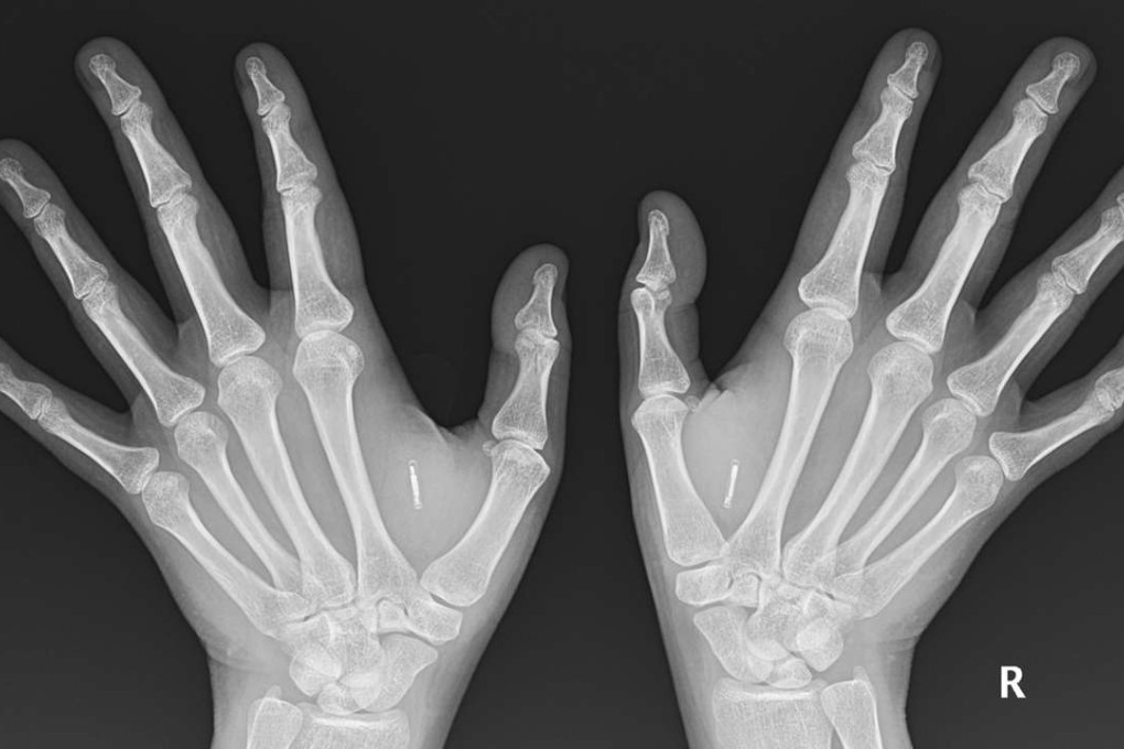 Shanti Korporaal’s implants can clearly be seen in this X-ray between thumb and forefinger on each hand.
