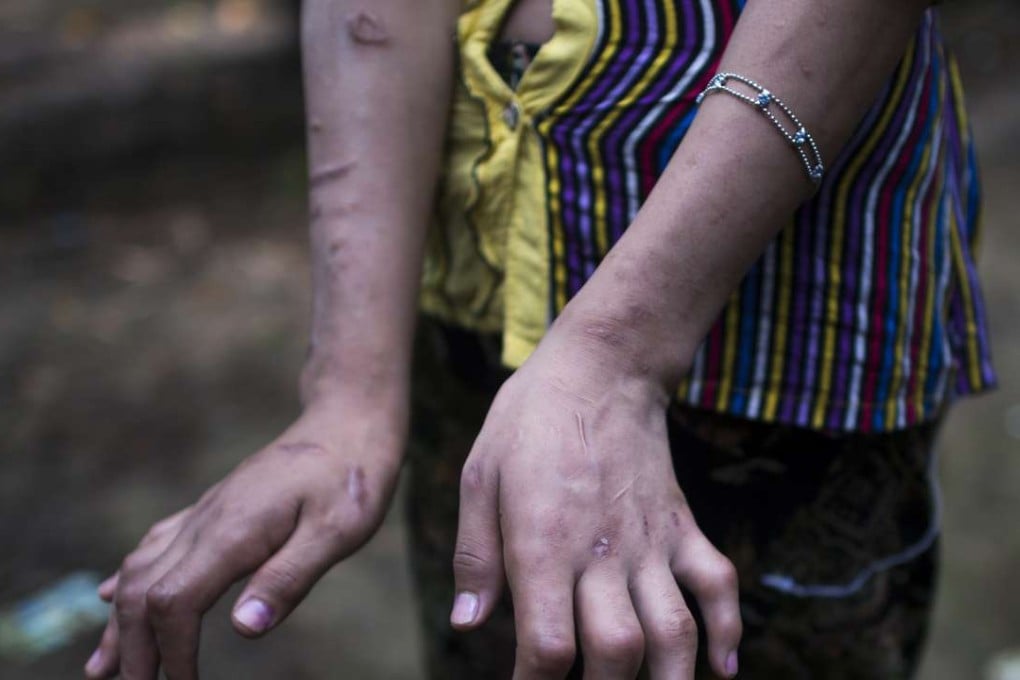 San Kay Khine, a 17-year-old Myanmar child slave shows her scarred arms and twisted fingers whilst recovering in her family’s village in Baw Lone Kwin. Photo: AFP