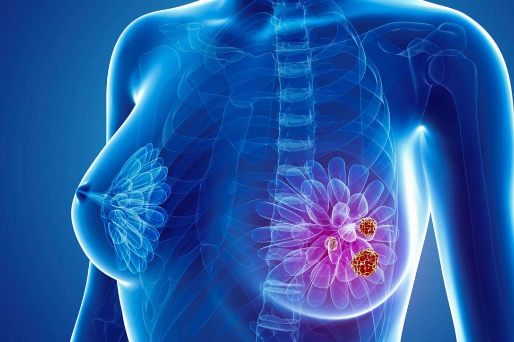 Lymphoedema is an incurable condition caused by breast cancer treatment and other surgery. Photo: Alamy