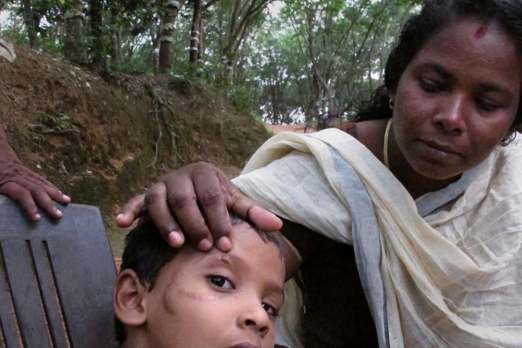 Seven-year old Ayoos Sajimon is slowly recovering from multiple surgeries after a dog bite. Two months ago, a street dog pounced on him, pressed its paws on his chest and bit his face and eye. The dog was killed by neighbours the week after. Photo: Washington Post/Rama Lakshmi