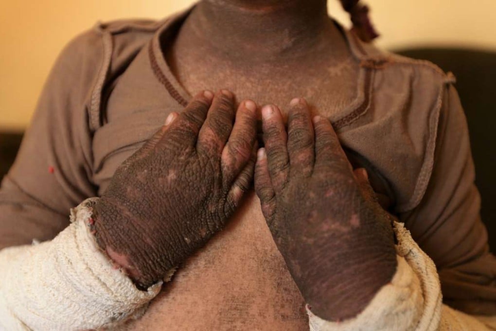 The skin on five-year-old Doaa's arms and neck is blackened and hardened after a suspected chemical-filled rocket fired by Islamic State landed and exploded in Qayyara, Iraq. Photo: Reuters