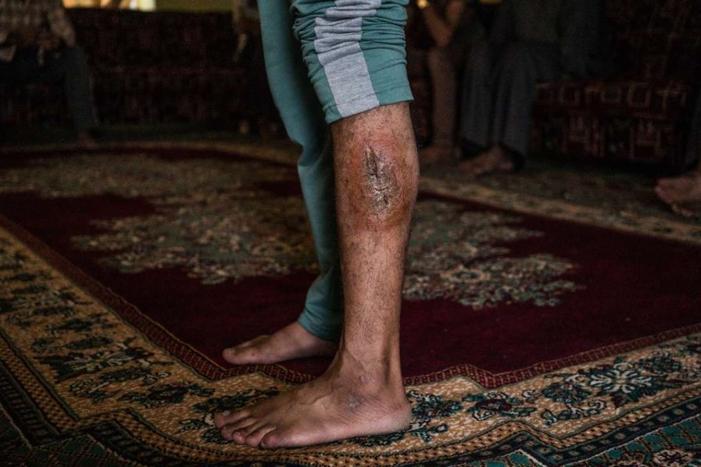 Islamic State victim Imad shows a bullet wound on his left leg that he says he suffered during a mass execution from which he escaped. Photo: Alice Martins / The Washington Post