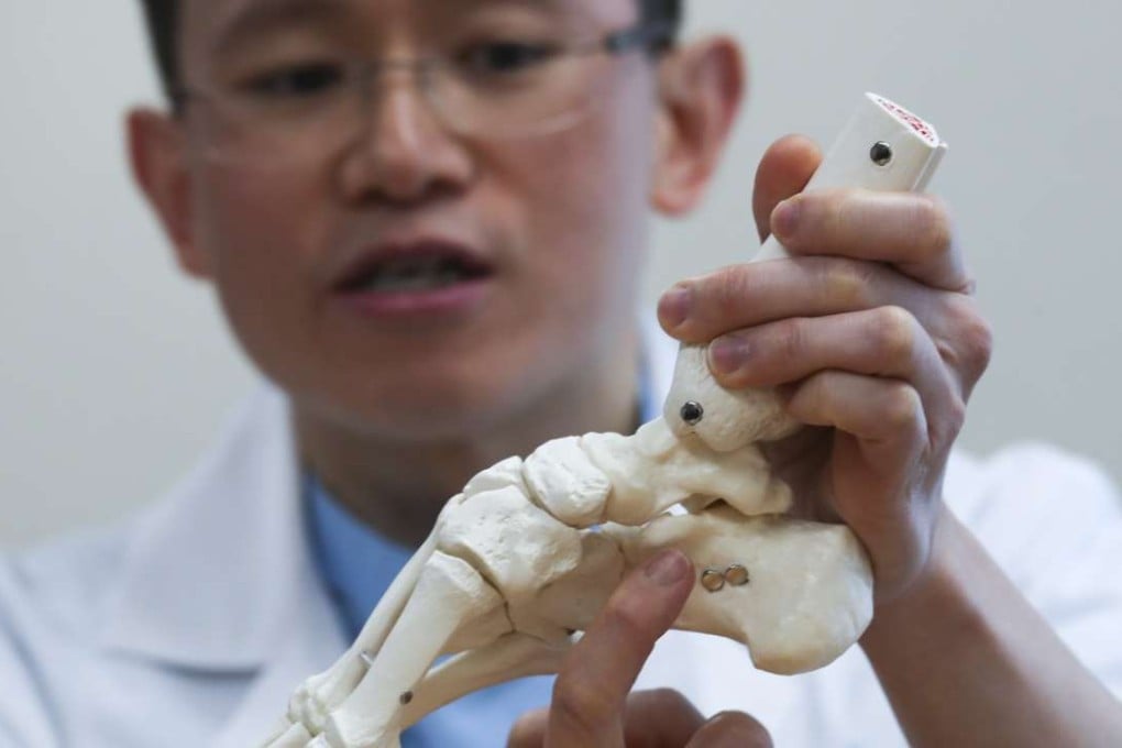 Dr Chiu Shin-yeung, a consultant at Pamela Youde Nethersole Eastern Hospital, displays a model of the talus bone in the foot. Photo: Nora Tam