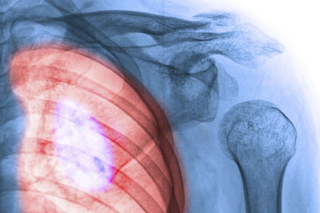 A study has revealed new genes linked to chronic lung disease.