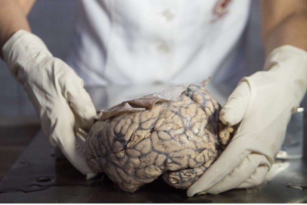 Differences in the brain sizes of people with ADHD, compared to people without the condition, suggest that it has a physiological cause, researchers say. Photo: AFP