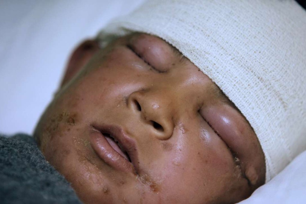 Yasser Hamid Nadm, 11 years old, is treated for possible exposure to chemical weapons agents in a hospital west of Erbil in Mosul. Photo: Reuters