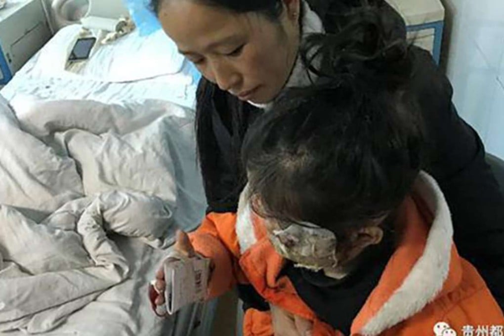 The girl was left with burns on her face and hands. Photo: Handout