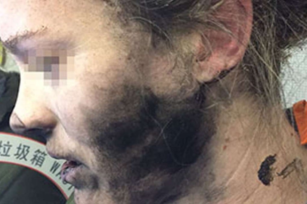 The woman suffered burns to her face and hands after her headphones caught fire during a flight to Australia. Photo: ATSB