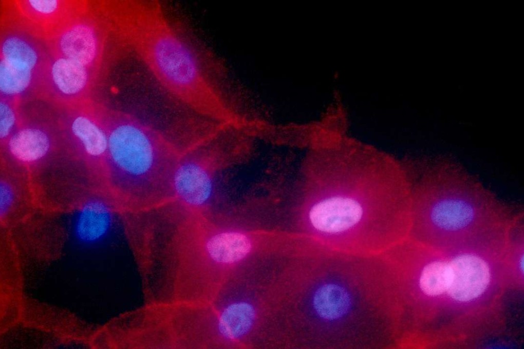 A fluorescence-coloured microscope image made available by the National Institutes of Health in September 2016 shows a culture of human breast cancer cells. Environmental risks and heredity get the most blame for cancer, but new research suggests random chance may play a bigger role than people realise. Photo: National Cancer Institute via AP