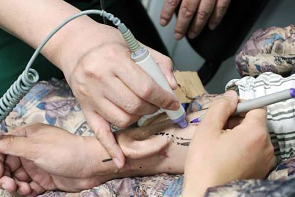 Doctors in Xian created an entirely new ear on the patient’s arm. Photo: Handout