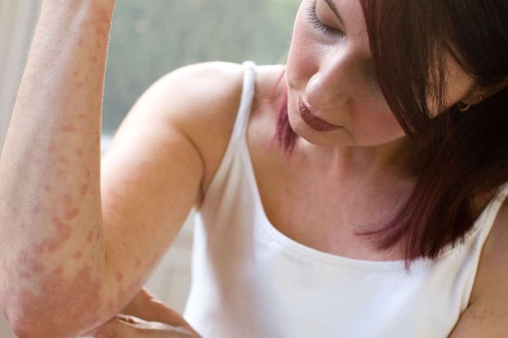 A growing proportion of the world’s population suffers from allergies.
