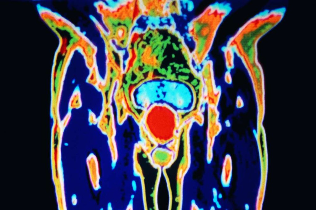 A thermograph shows evidence of prostate cancer. But doctors have long advised that patients, particularly the elderly, are more likely to die with the disease, than because of it. Photo: Corbis