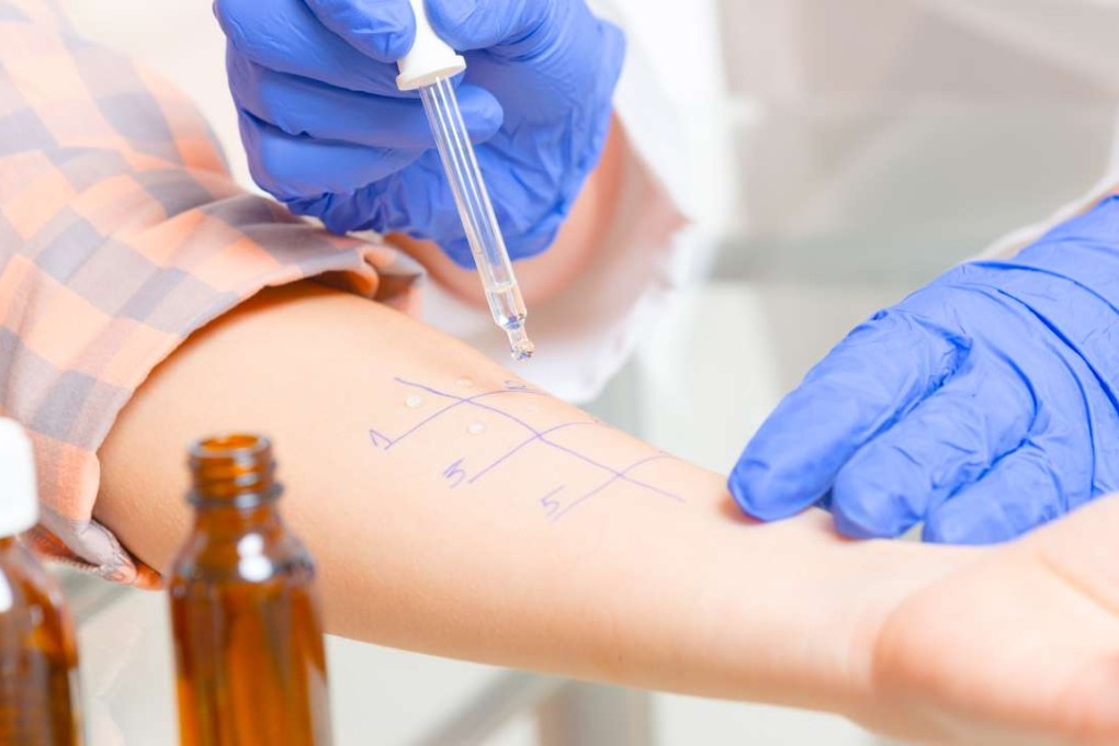 An adult undergoes an allergy test. An allergy to gluten picked up in early childhood may trigger an autoimmune disease in adulthood. Photo: Shutterstock