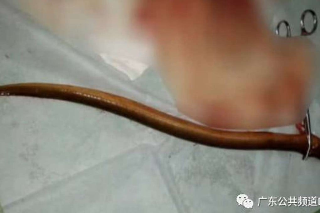 Doctors removed the live eel from the patient’s stomach. Photo: Handout