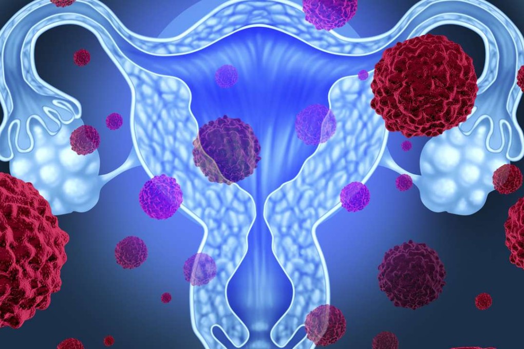 There are many myths surrounding ovarian cancer, one of the biggest causes of cancer deaths in Hong Kong women.
