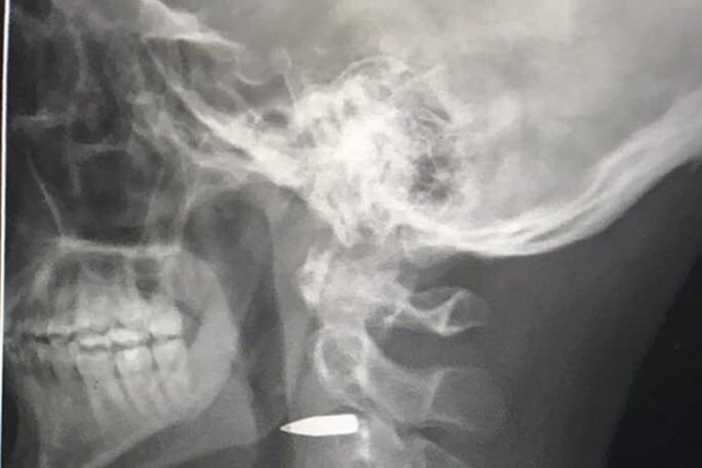 Adam Harvey’s X-ray shows a bullet lodged near his neck after being shot while covering the Philippine military's assault on militants. Photo: AP