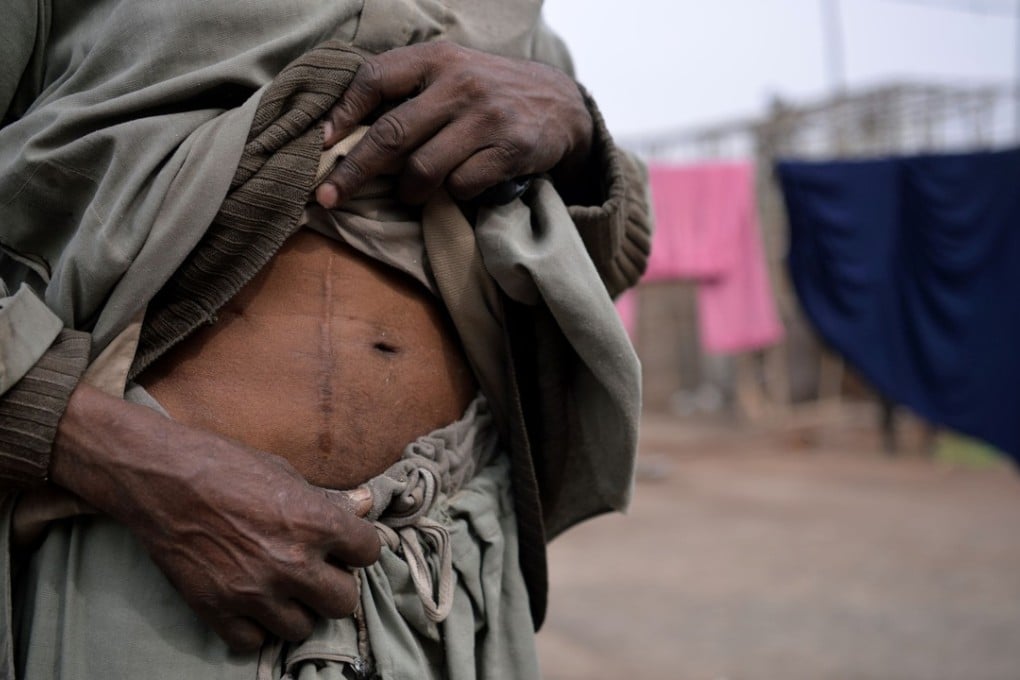 Maqsood Ahmed, who sold one of his kidneys, shows his scar. Photo: AFP