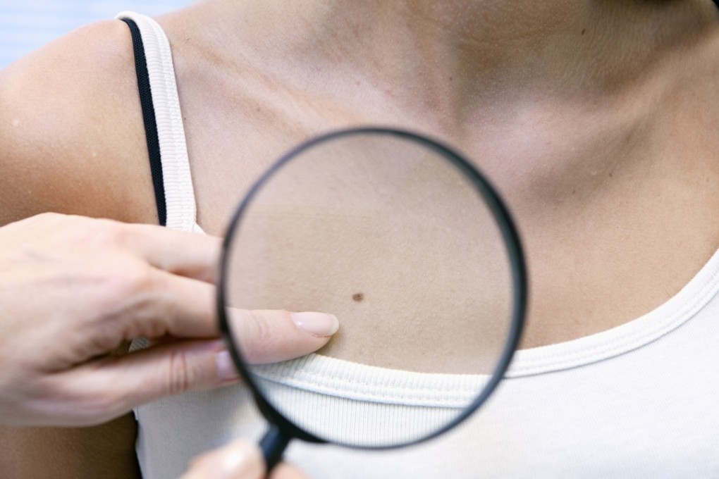 A doctor examines a melanoma on a woman’s torso. Melanoma is the most serious type of skin cancer. Photo: B. Boissonnet/BSIP