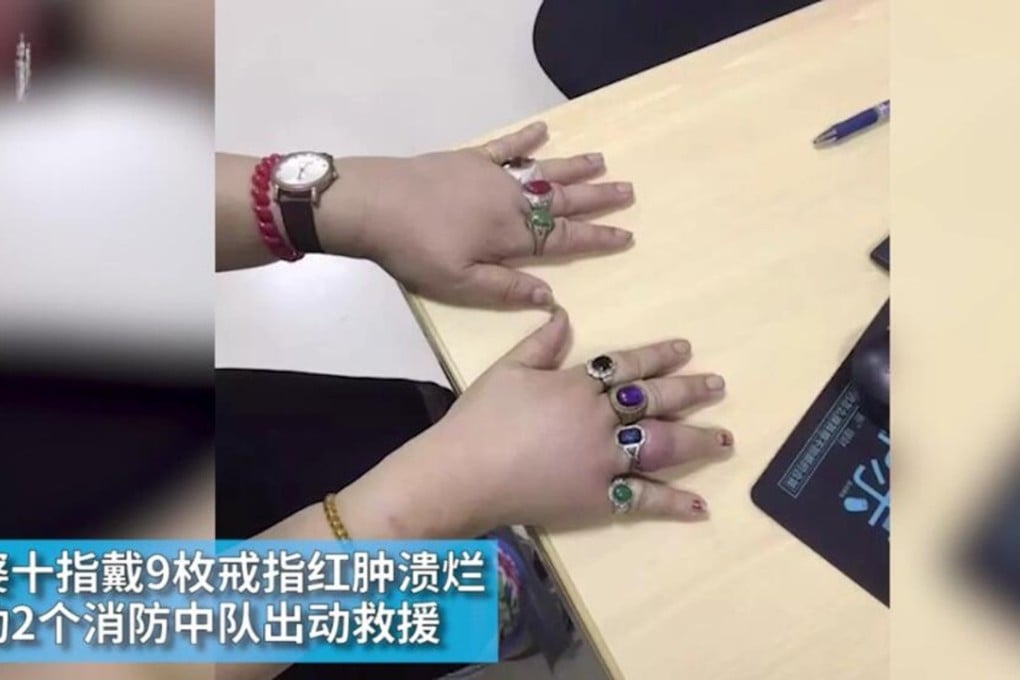 The woman’s swollen fingers before most of the rings were removed. Photo: Thepaper.cn
