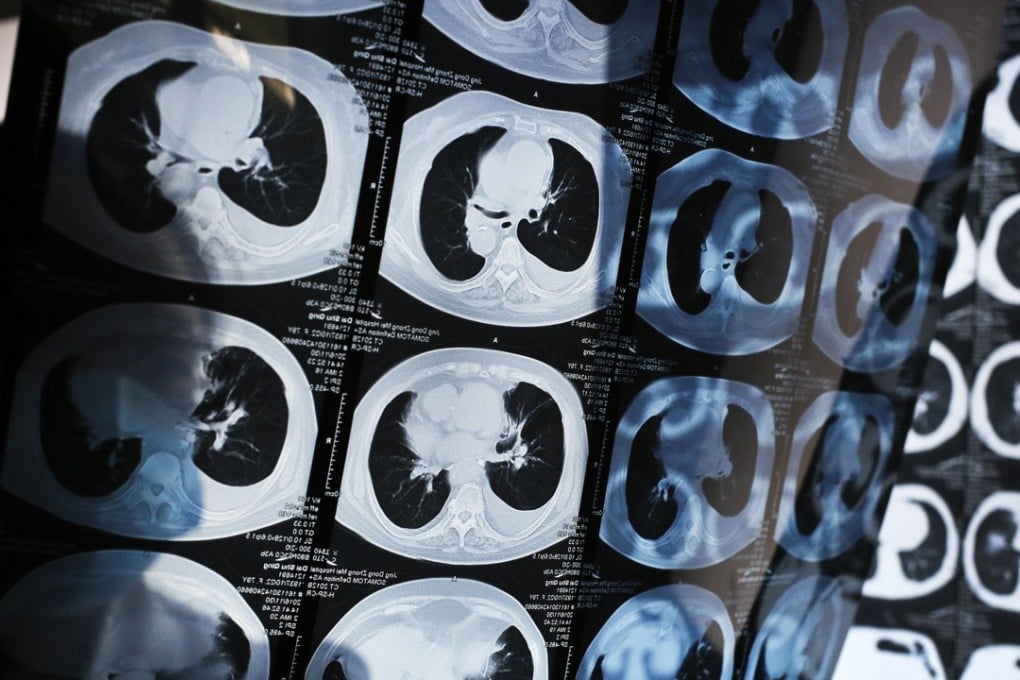 A Chinese doctor browses CT scans of patients at a private hospital in Yanjiao, Hebei Province. AI promises to decrease workload on doctors and improve diagnosis accuracy. Photo: AP