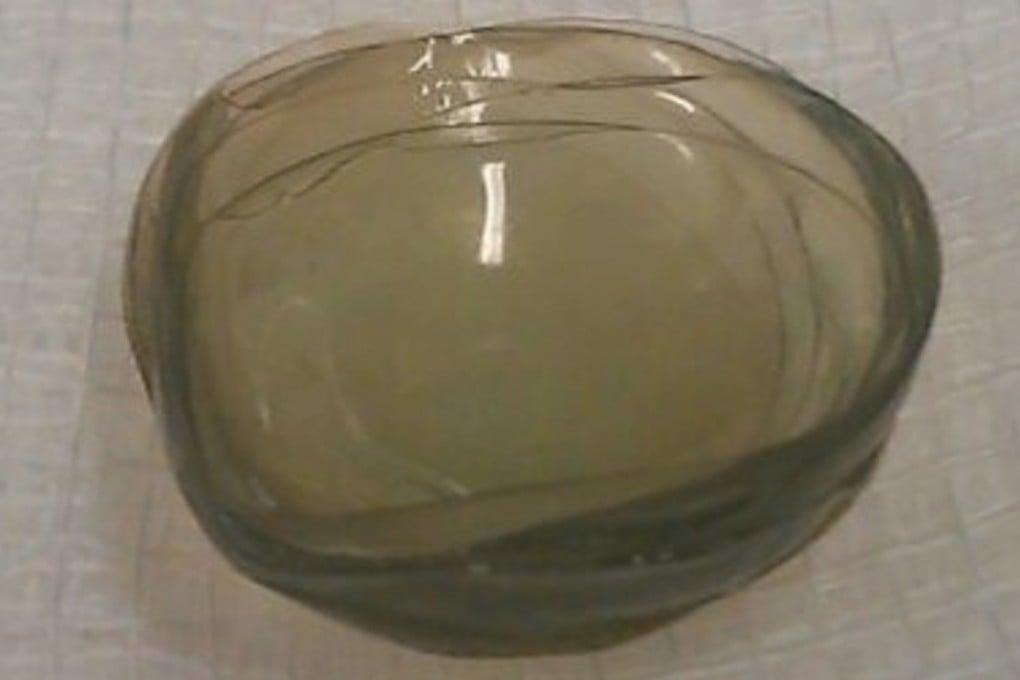 The clump of 27 contact lenses that British doctors found in an elderly patient's eye. Photo: BMJ / Twitter