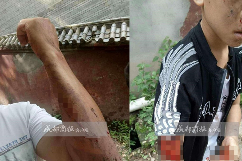 The father and son show off their injuries after being attacked by a troop of monkeys. Photo: Handout
